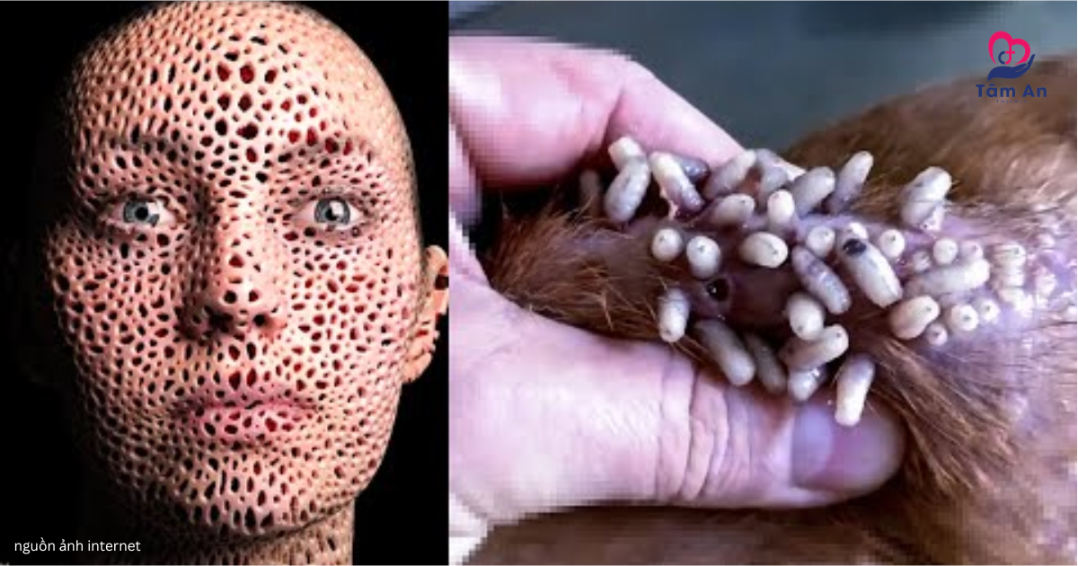 Khi trypophobia bị khuếch đại bởi trào lưu và nội dung trên mạng xã hội